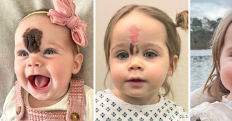 Padres recurrieron a una cirugía para eliminar una rara marca de nacimiento en el rostro de su hija