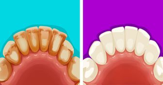 6 Maneras efectivas de eliminar la placa dental de forma natural