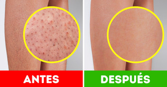 7 Remedios caseros para tratar la piel de fresa y lucir unas piernas suaves y radiantes