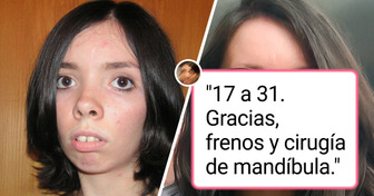 18 Personas que transformaron su apariencia con cirugía plástica y lograron resultados asombrosos