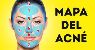 Qué es el mapa del acné y cómo puede ayudarte a deshacerte de tus problemas de salud