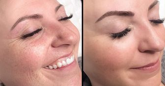 9 Métodos confiables para eliminar los poros abiertos en el rostro