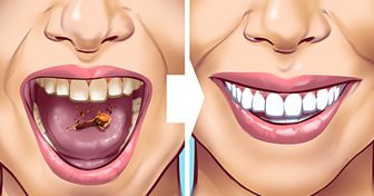 10 Formas de eliminar las manchas de sarro en tus dientes