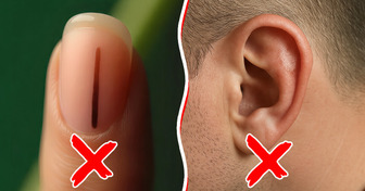 6 Señales tempranas de melanoma que la mayoría suele ignorar