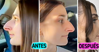 El increíble antes y después de una mujer que pasó una década ahorrando para su cirugía de nariz