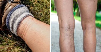 4 Problemas de salud que las marcas de calcetín podrían estar indicándote