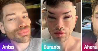Un hombre muestra los impactantes resultados de su cirugía de ojos y la retirada de rellenos faciales, dejando a todos asombrados
