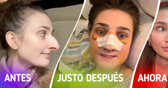 Una mujer comparte los resultados de su cirugía plástica y deja a todos asombrados con su transformación