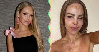 Katie Piper refleja su increíble transformación 16 años después del ataque con ácido