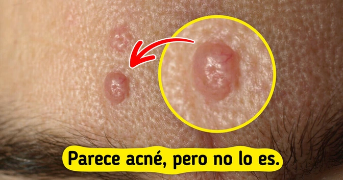 7 Bultitos en la piel que podrías confundir con acné (y no lo son)