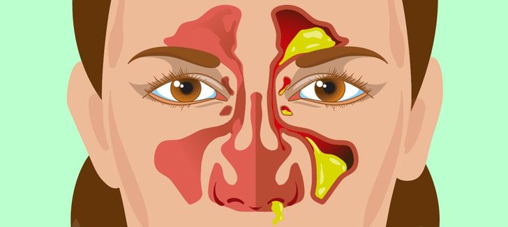 Cómo eliminar los mocos de la nariz? Drr Mocos • NEUMOFISIO