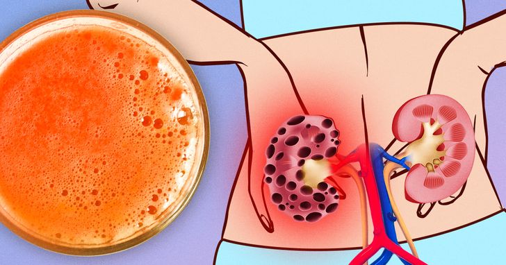 7 Alimentos populares que pueden arruinar tus riñones