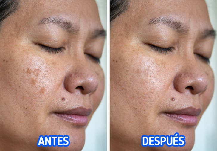 Qué causa la pigmentación de la piel y 4 formas de evitarla