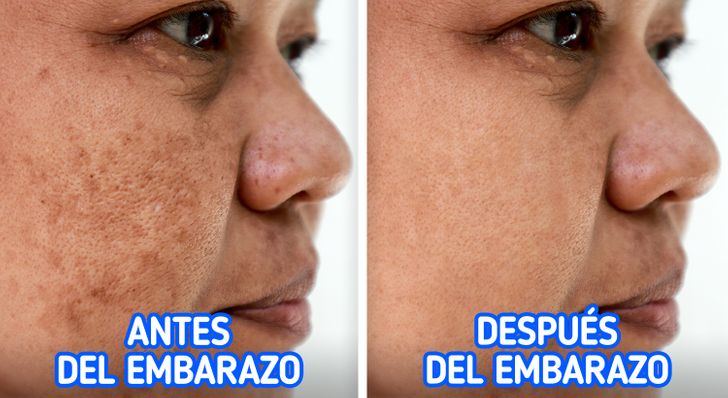 Qué causa la pigmentación de la piel y 4 formas de evitarla