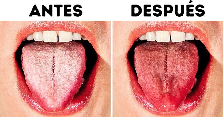 envío Creación Irónico 10 Maneras de deshacerse de la lengua blanca y hacerla más saludable