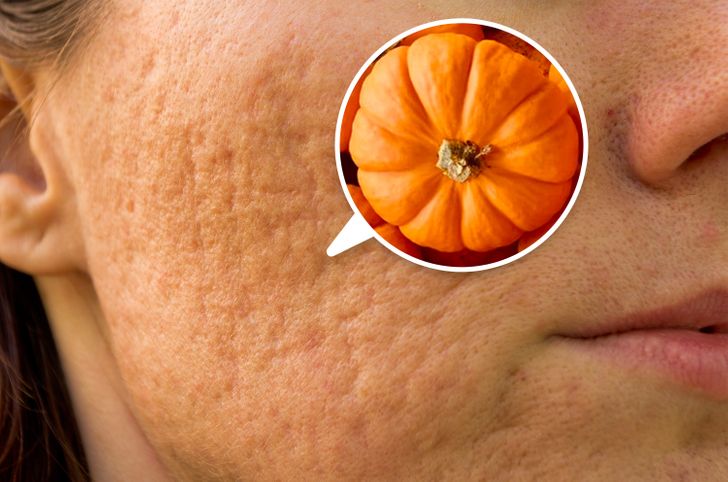 7 Alimentos que reducen las cicatrices del acné